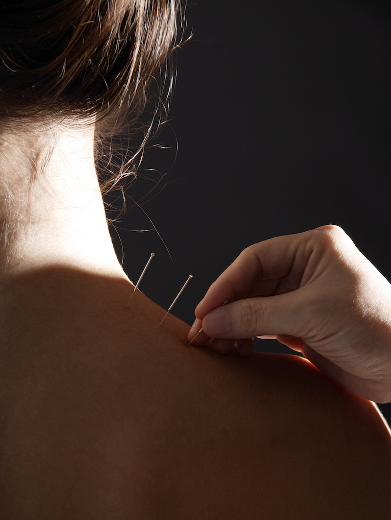 Woman Receiving Acupuncture