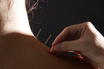 Woman Receiving Acupuncture